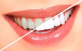 PureSmile - creion de albire dentară