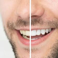 PureSmile - creion de albire dentară